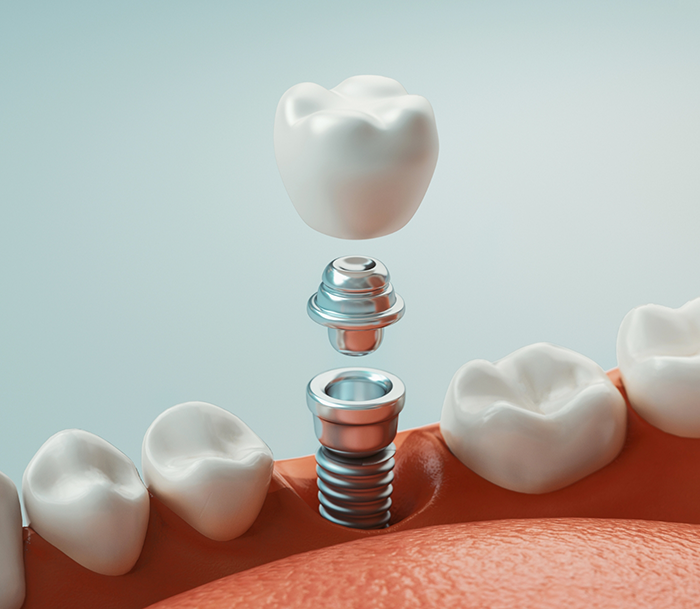 Illustration of a dental implant replacing a missing tooth