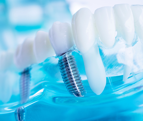 Model of the mouth with two dental implants supporting a bridge