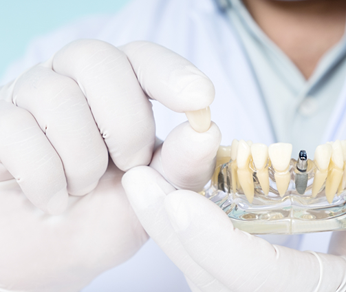 Dentist holding a dental implant model and a dental crown