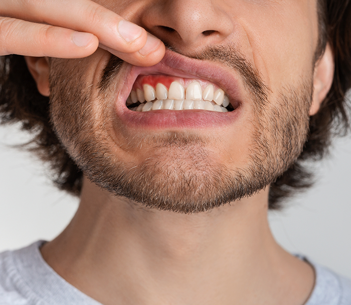 Man pointing to a red spot in his gums before gum disease treatment