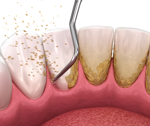 Illustrated dental scaler clearing tartar buildup from the teeth and gums