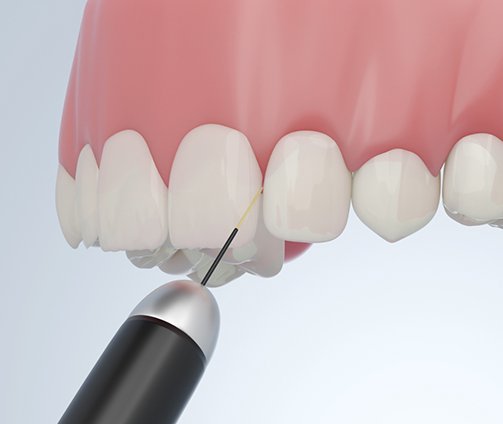 Illustration of a dental laser treating the gums