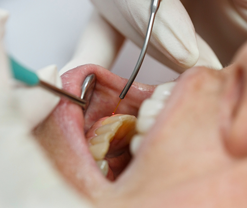 Close up of a dental patient having their gums treated with a laser