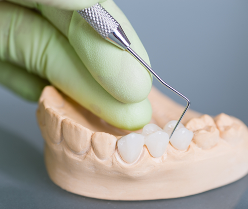 Dental bridge replacing three missing teeth in a model of the mouth