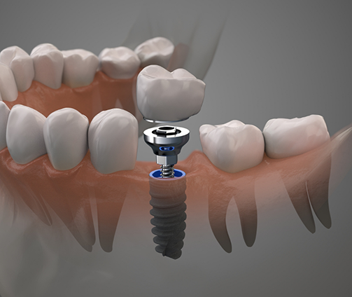 Illustration of a dental implant replacing a missing tooth