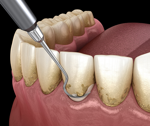 Illustration of a dental scaler clearing tartar buildup from the teeth and gums
