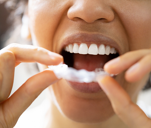 Close up of a person placing a nightguard tray over their teeth