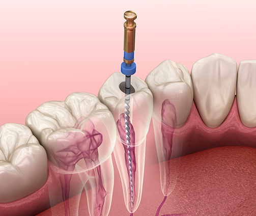 Illustration of a dental instrument performing root canal treatment on the center of a tooth