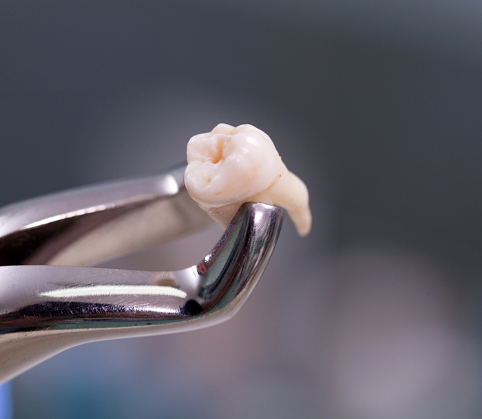 Forceps holding an extracted tooth