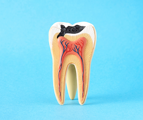 Model of a severely decayed tooth
