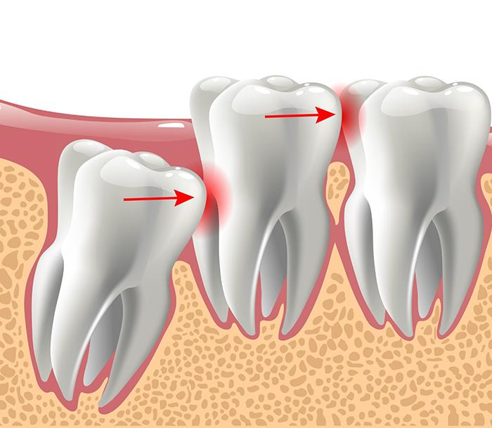 Illustration of an impacted wisdom tooth pressing against the adjacent tooth